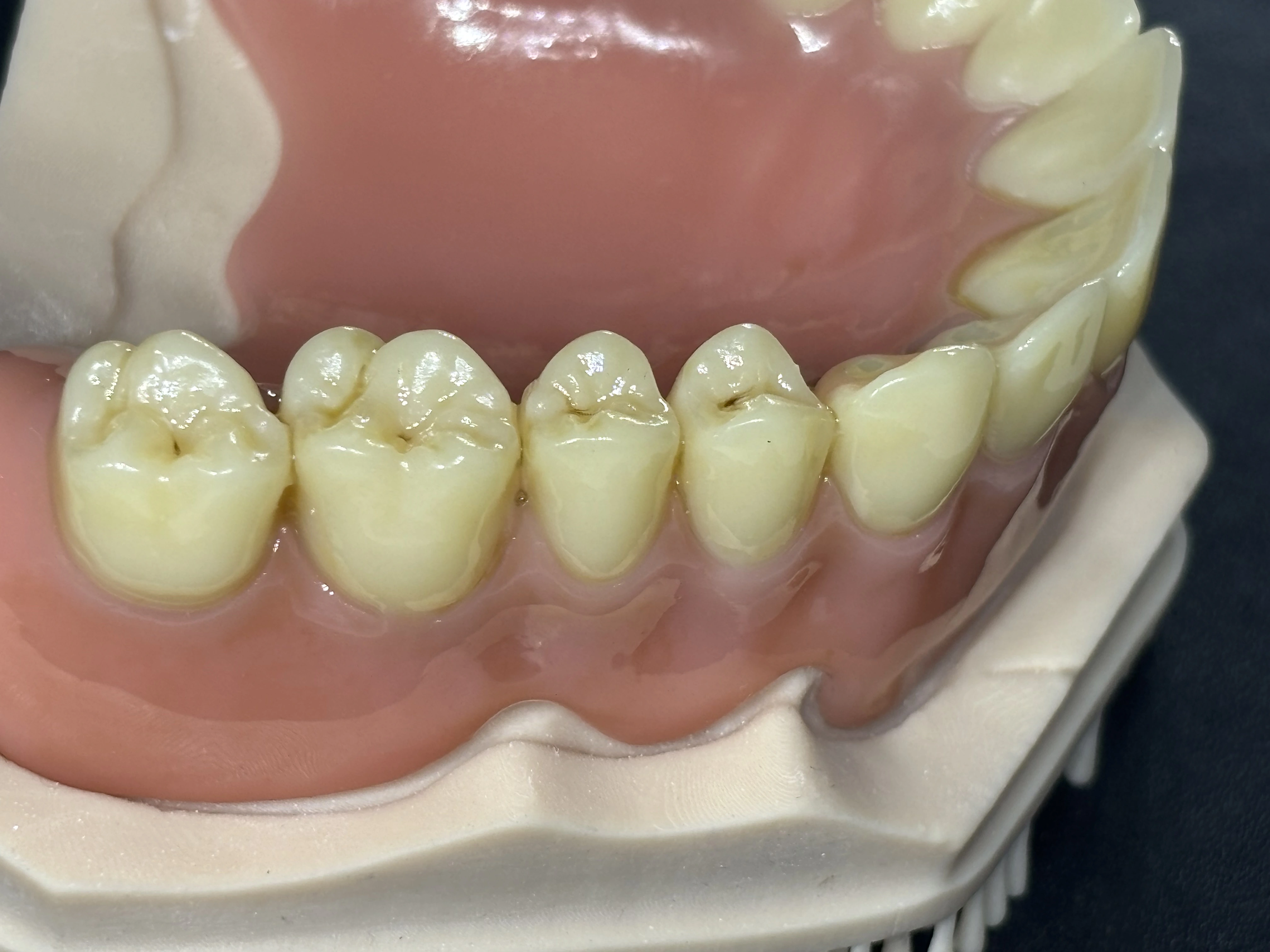 removable-denture